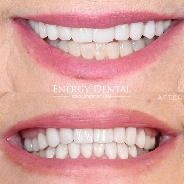 Before and after dental veneers in Houston, TX