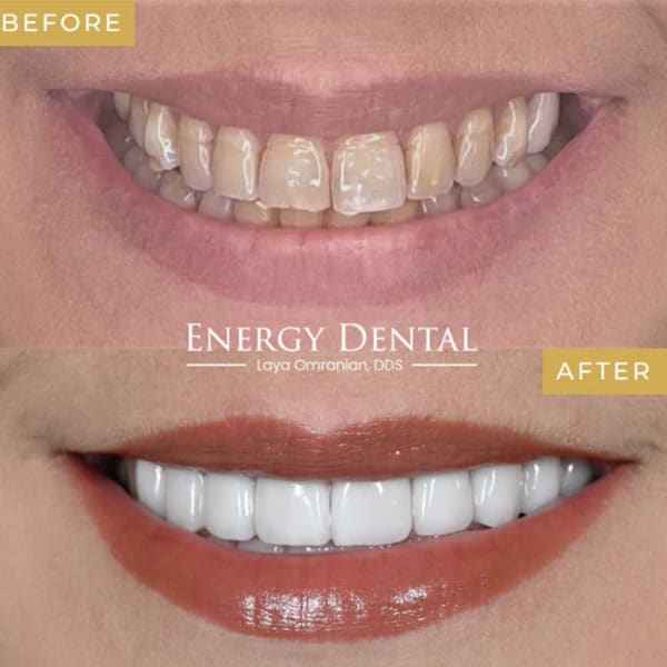 Before and after dental veneers in Houston, TX