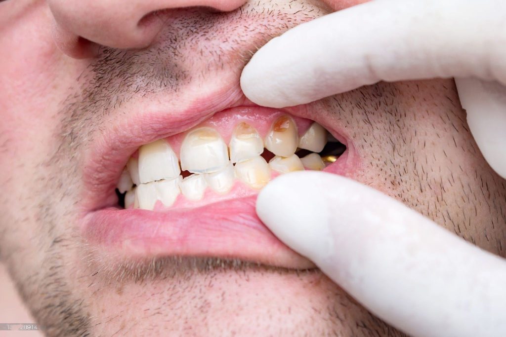 Man with decaying teeth