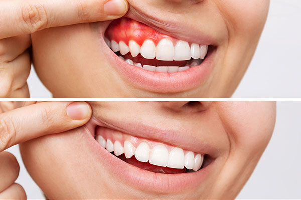 Infected gums versus healthy gums